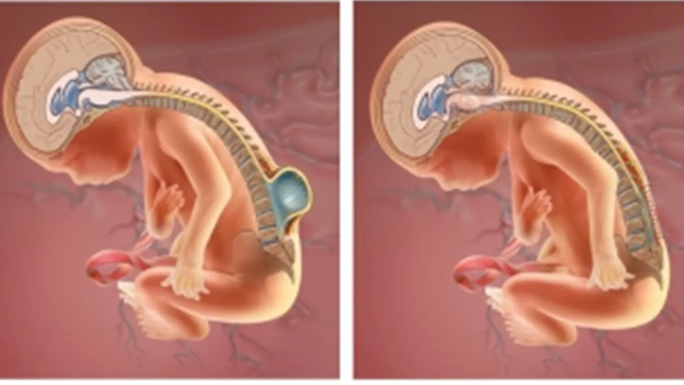 Bebé con espina bífida
