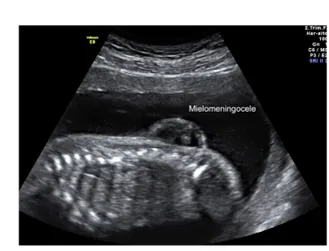 Espina Bífida