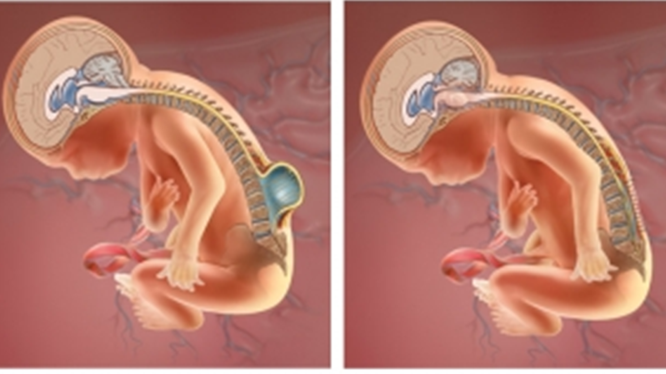 Bebé con espina bífida