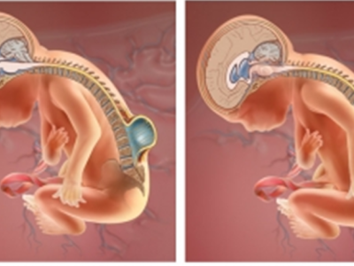 Bebé con espina bífida